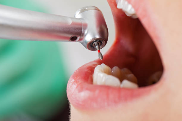 Best Emergency Tooth Extraction in Scanlon, MN